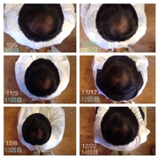 6ヶ月で発毛を実感頂く最速の育毛プログラムならココ!